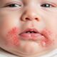 Teething Rash: The Connection Between Teething and Skin Irritation
